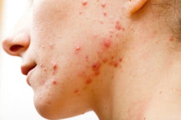 Top 10+ castor oil good for skin 2 30 Outstanding Castor Oil Uses and Benefits