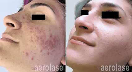 Acne Scar Treatment Results in Bloomington MN